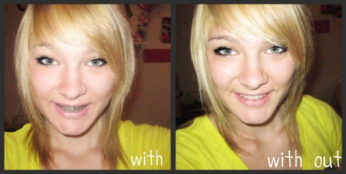 with & without braces =)