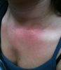 my wasp sting